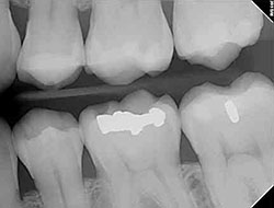 digital x-rays