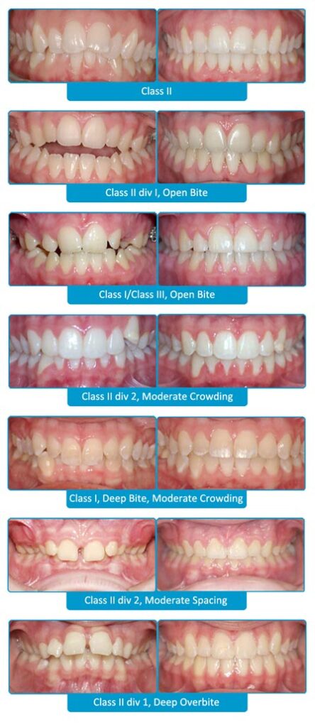 SureSmile before and after