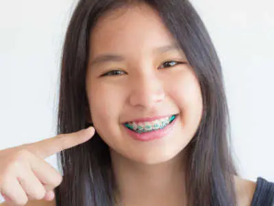 Different Types of Braces for Teens - Invisalign, Clear, White are Some of the Types of Braces