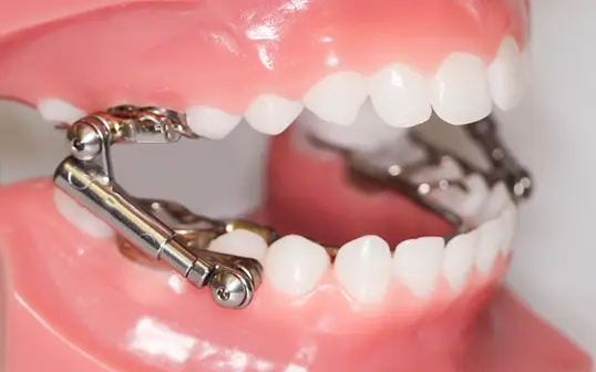 Herbst Appliance - Focuses on the lower jaw to align better