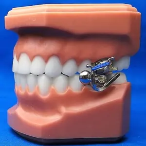 MARA-Appliance - Moves the lower Jaw Forward to Align the Upper and Bottom Teeth