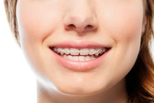 Clear Braces Are They Right For You - Mariana Orthodontics