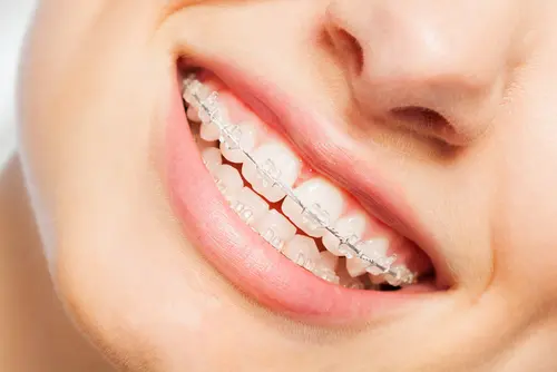 Clear Braces - Mariana Orthodontics