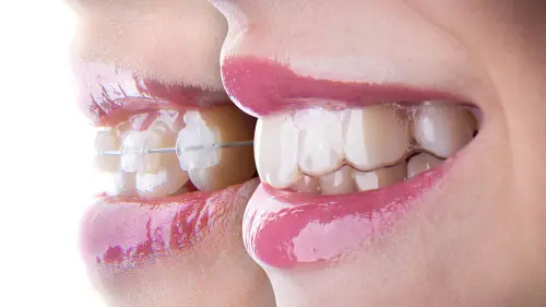 Different Types of Braces - Mariana Orthodontics
