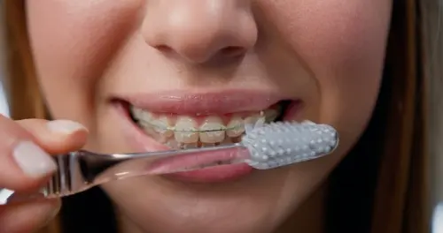 Caring for Your Clear Braces - Mariana Orthdontics