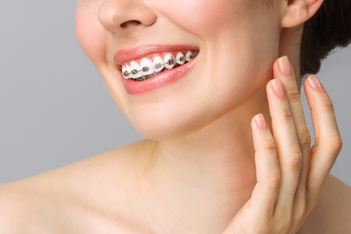Braces FAQs - Mariana Orthodontics 