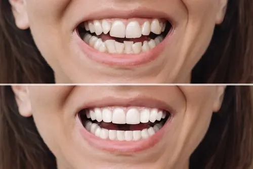 What Problems Do Braces Fix - Mariana Orthodontics