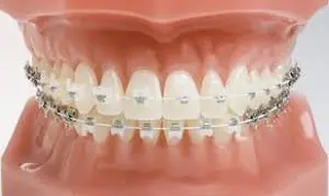 Empower Clear Braces - Dr. Mariana Orthdontics